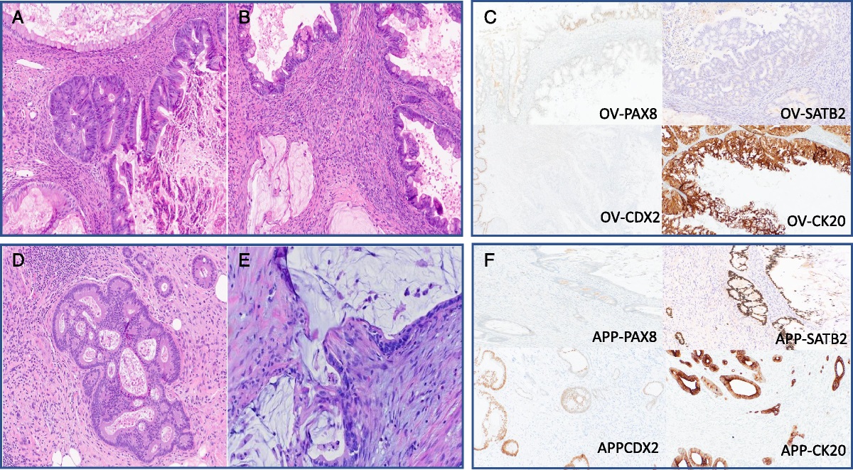 Synchronous Mucinous Carcinomas of Ovary and Appendix: A Case Report With Diagnostic Pitfalls and Review of Corresponding Literature