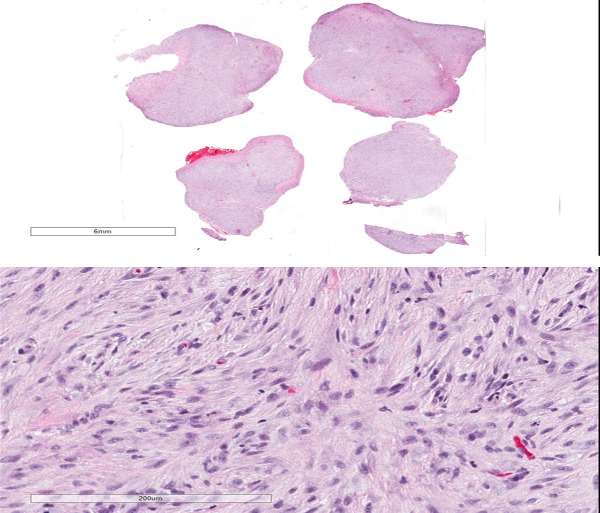 Sarcomatoid Mesothelioma With Bland Histologic Features: A Potential Pitfall in Diagnosis