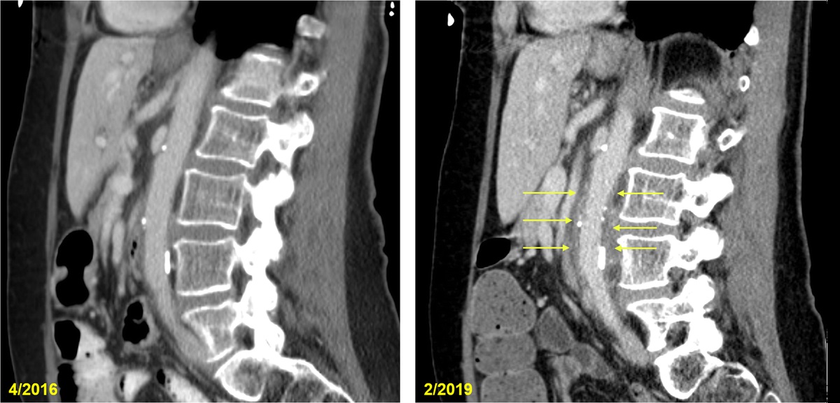 An Atypical Presentation of Abdominal Aortic Aneurysm: A Cryptogenic Case of Aortitis