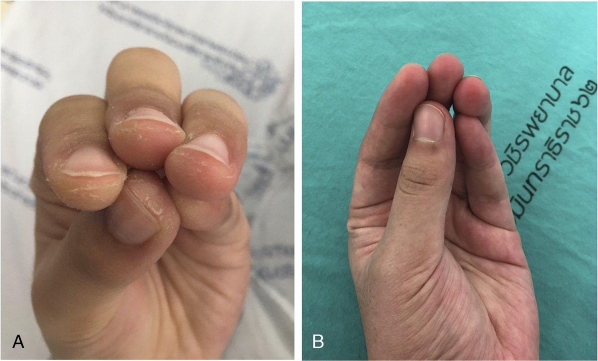 Mechanic's Hands Mimicking Hand Eczema
