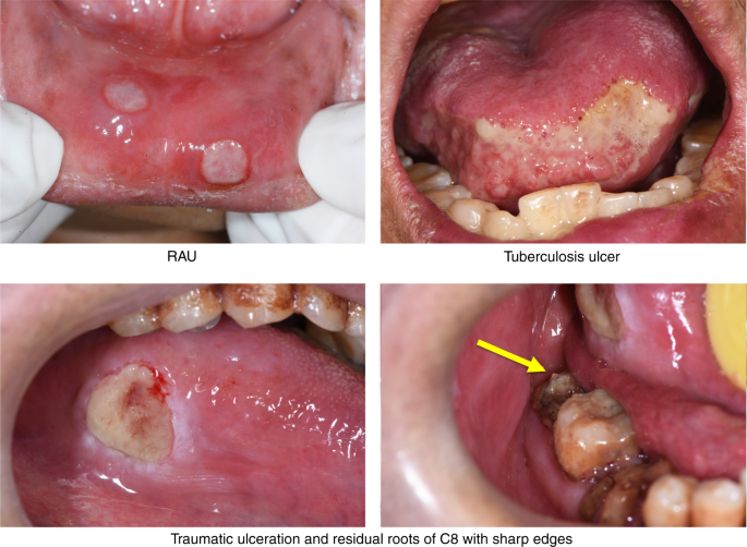 Difficult and complicated oral ulceration: an expert consensus guideline for diagnosis