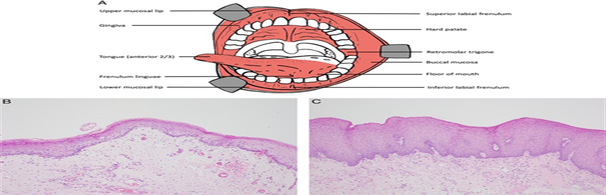 Oral Epithelial Dysplasia: A Review of Diagnostic Criteria for Anatomic Pathologists