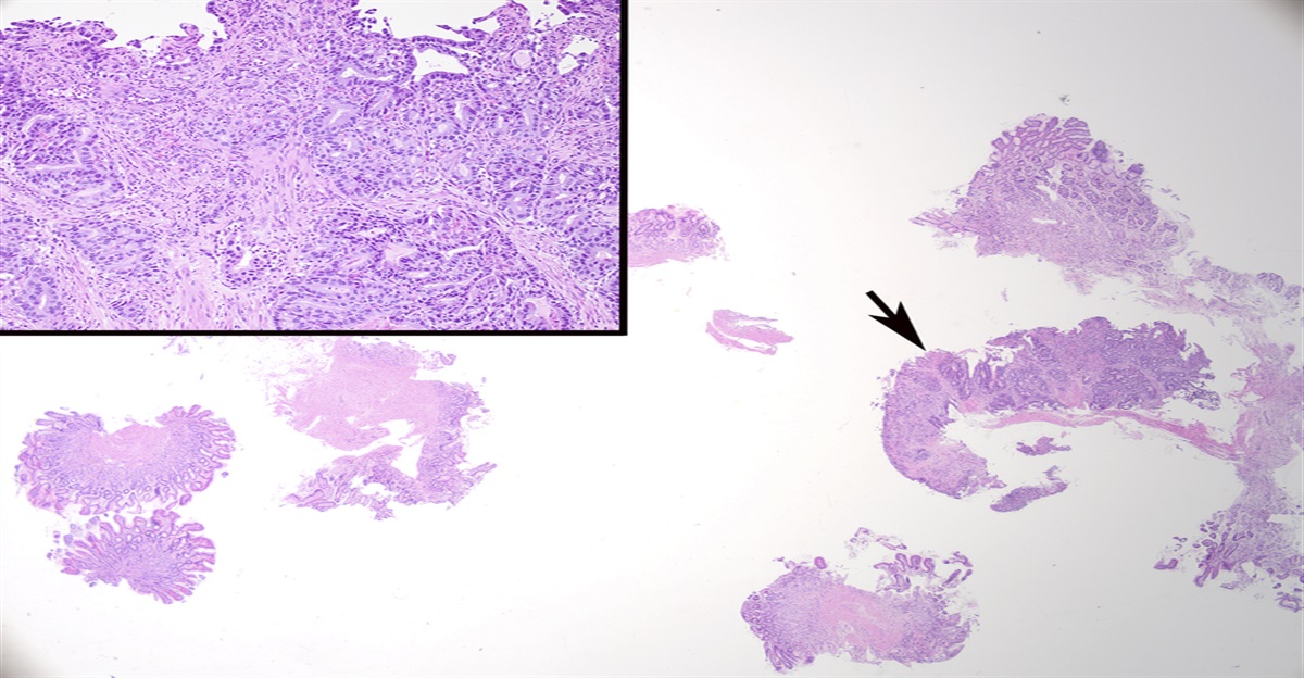 Successful Identification of a Neoplastic Tissue Contaminant in Surgical Pathology
