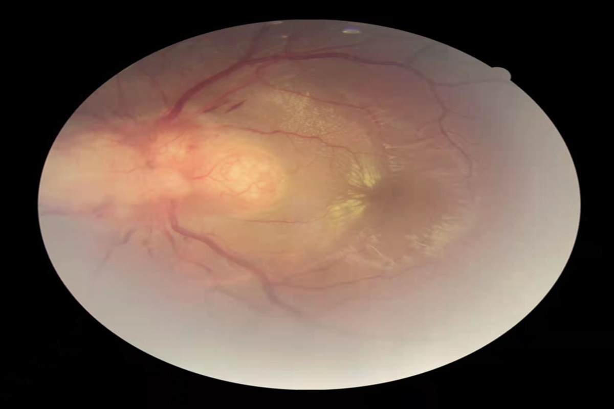 Case Report: Multiple Ocular Manifestations Assisted in the Diagnosis of Systemic Sarcoidosis