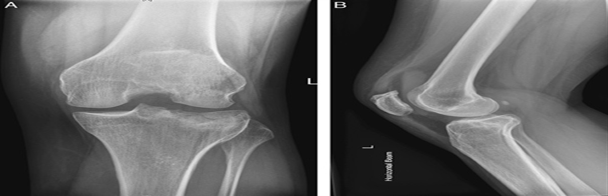 Posterolateral Tibial Plateau Depression Fracture Reduction and Fixation: A Novel Approach