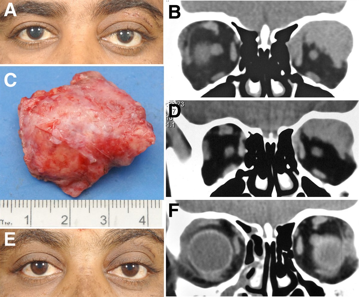 Does Multimodal Treatment Improve Eye and Life Salvage in Adenoid Cystic Carcinoma of the Lacrimal Gland?