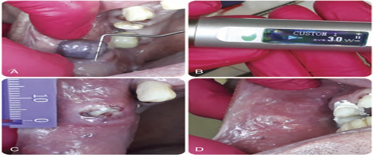 Diode Laser Management of Cheek Cavernous Hemangioma in Dental Office