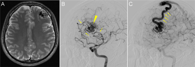 Genetics of brain arteriovenous malformations and cerebral cavernous malformations