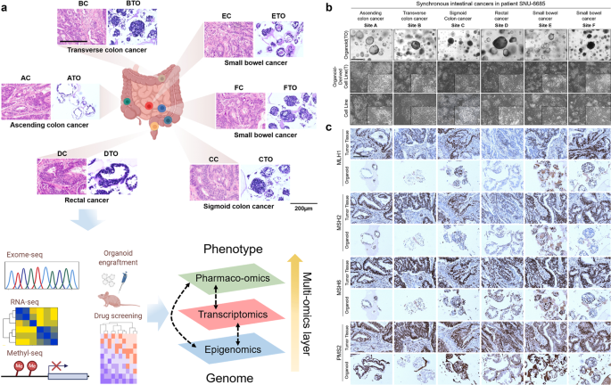 Multifocal organoids reveal clonal associations between synchronous intestinal tumors with pervasive heterogeneous drug responses