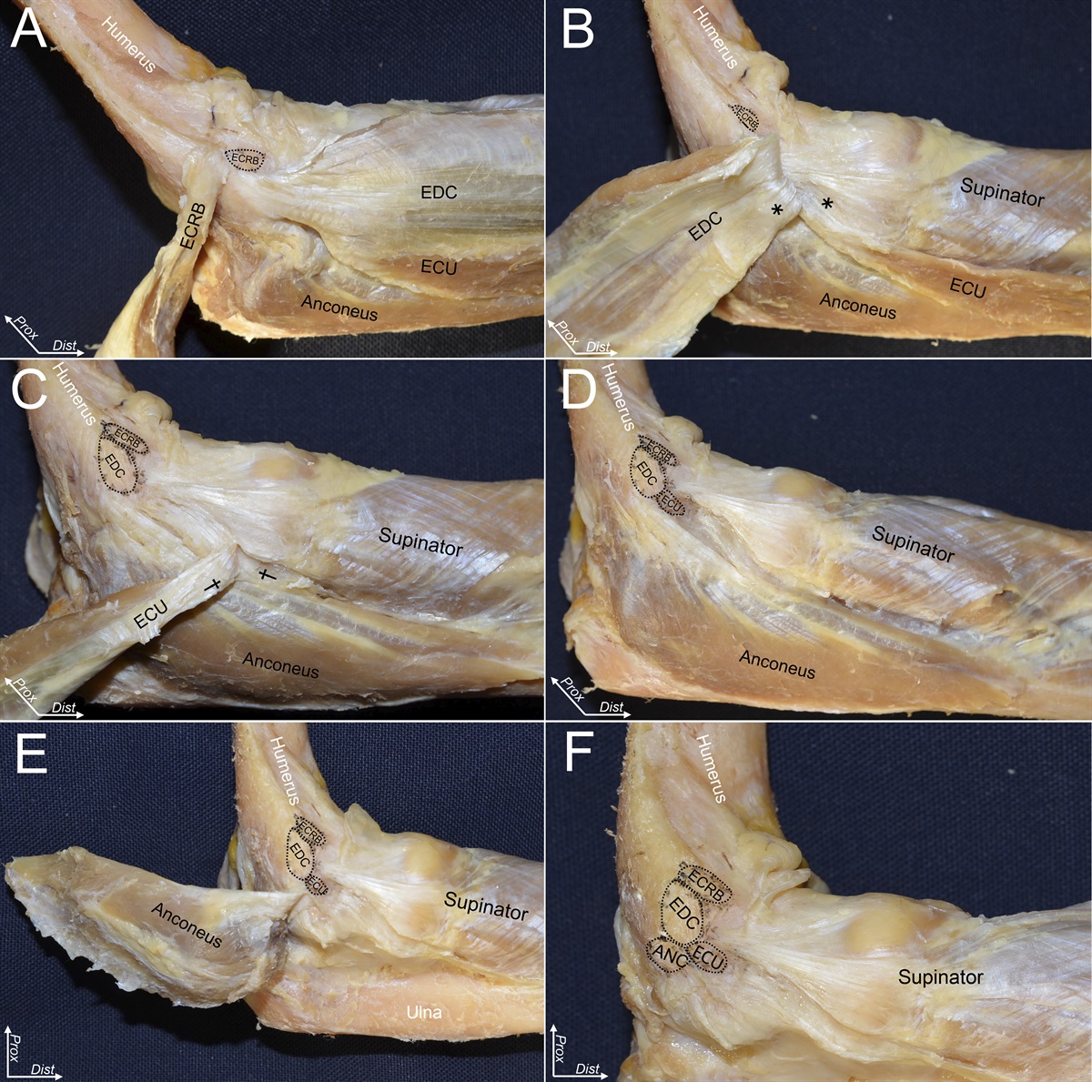 Lateral Ulnar Collateral Ligament of the Elbow Joint: Reconsideration of Anatomy in Terms of Connection with Surrounding Fibrous Structures