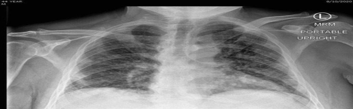 Chest X-Ray Findings in Patients With COVID-19 Pneumonia