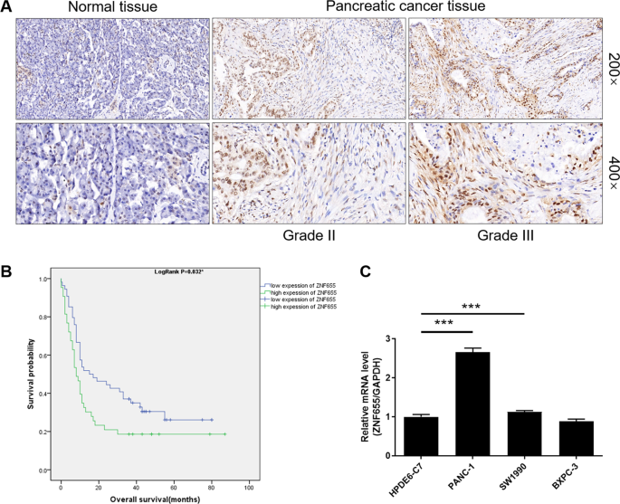 ZNF655 accelerates progression of pancreatic cancer by promoting the binding of E2F1 and CDK1