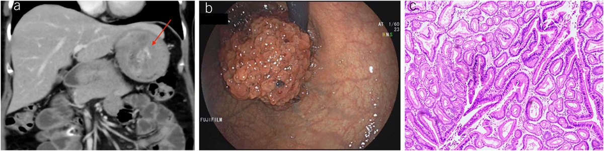Large Gastric Pyloric Gland Adenoma