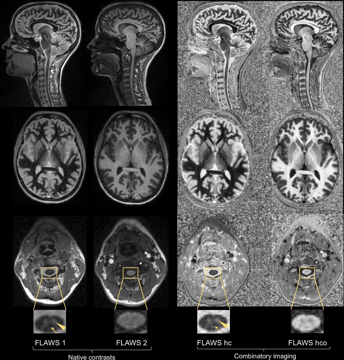 3-Dimensional Fluid and White Matter Suppression Magnetic Resonance Imaging Sequence Accelerated With Compressed Sensing Improves Multiple Sclerosis Cervical Spinal Cord Lesion Detection Compared With Standard 2-Dimensional Imaging