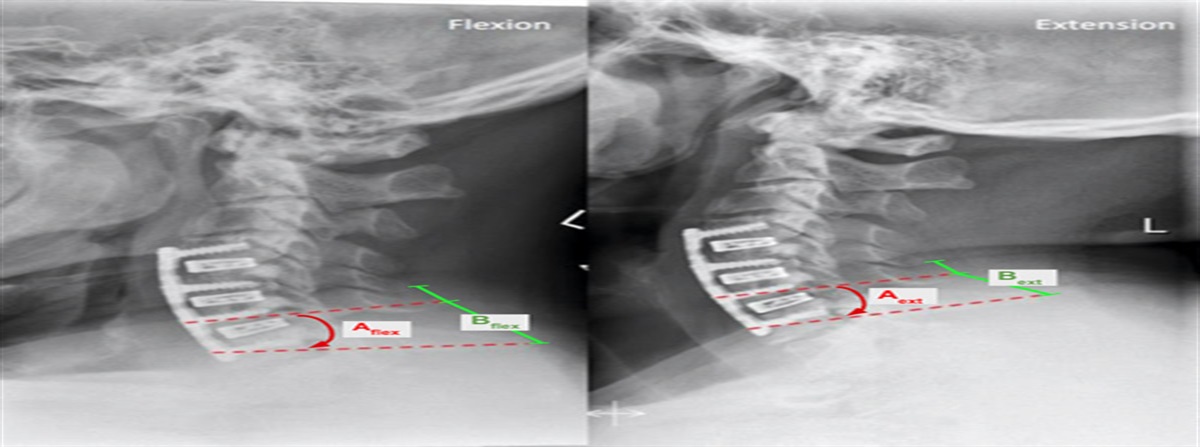 Assessing Postoperative Pseudarthrosis in Anterior Cervical Discectomy and Fusion (ACDF) on Dynamic Radiographs Using Novel Angular Measurements