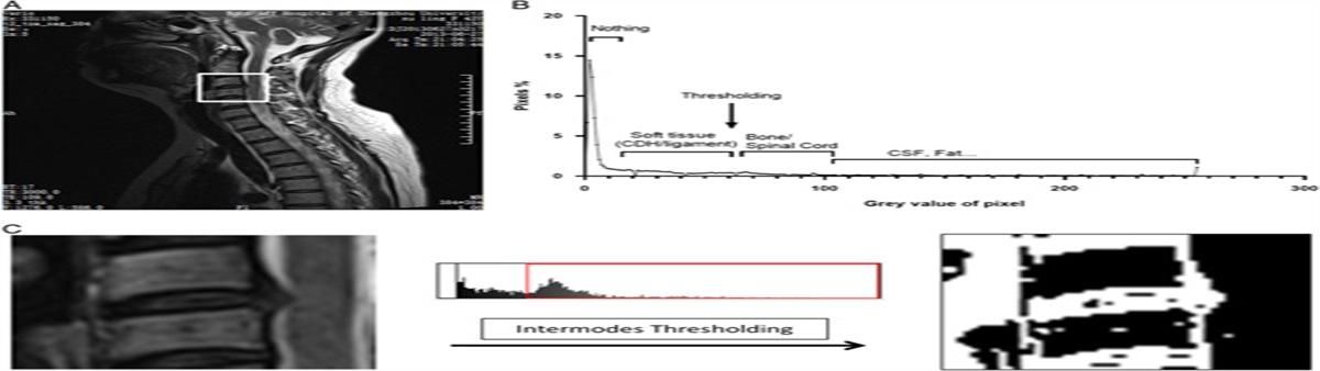 A New Automated AI-Assisted System to Assess Cervical Disc Herniation