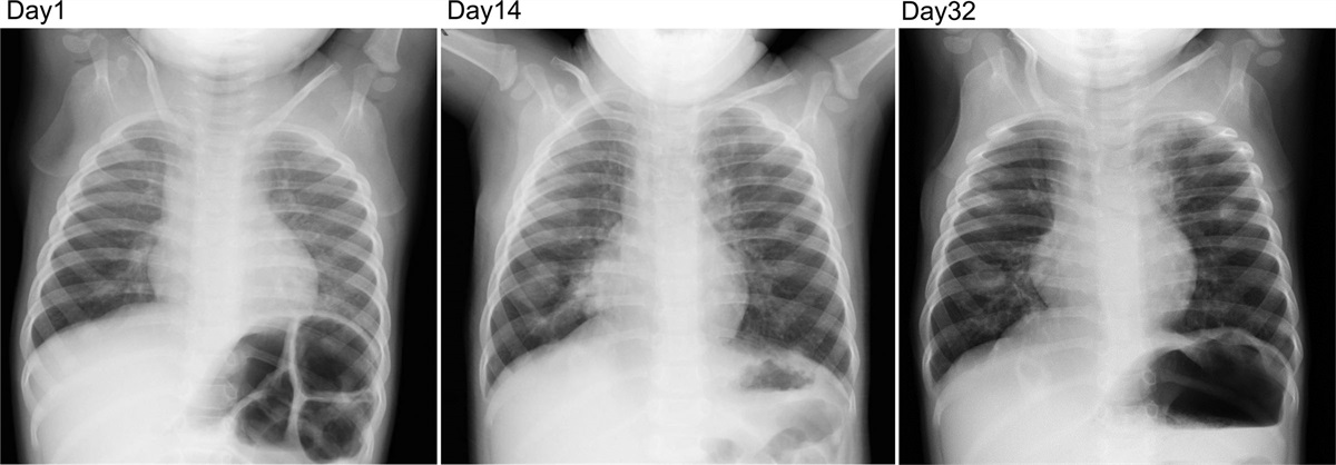 Respiratory Condition Exacerbated While Using Broad-spectrum Antibiotic and Steroid: A Case of 1-Year-old Girl