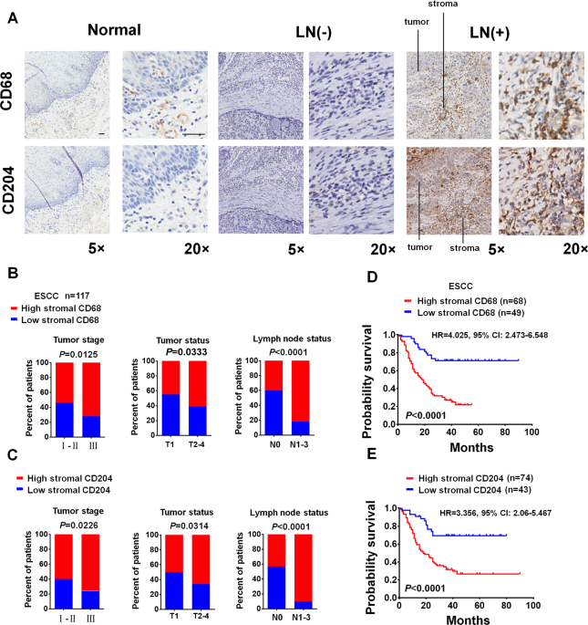 Tumor-associated macrophage (TAM)-derived CCL22 induces FAK addiction in esophageal squamous cell carcinoma (ESCC)