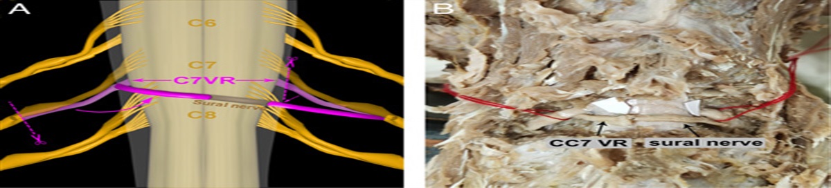 A Cadaver Feasibility Study of Extradural Contralateral C7 Ventral Root Transfer Technique for Treating Upper Extremity Paralysis