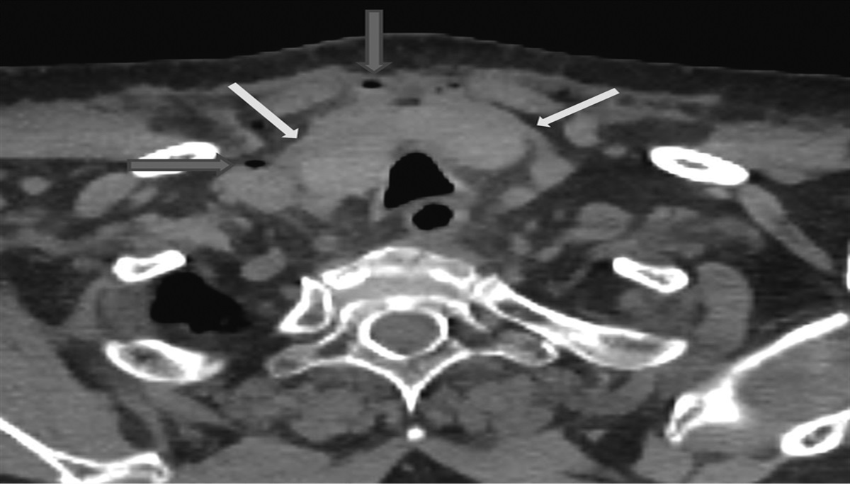 Sudden Death Due to Cervical Necrotizing Soft Tissue Infection