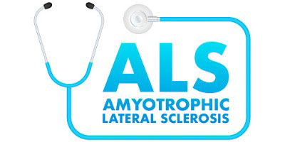 Articulatory Underpinnings of Reduced Acoustic–Phonetic Contrasts in Individuals With Amyotrophic Lateral Sclerosis