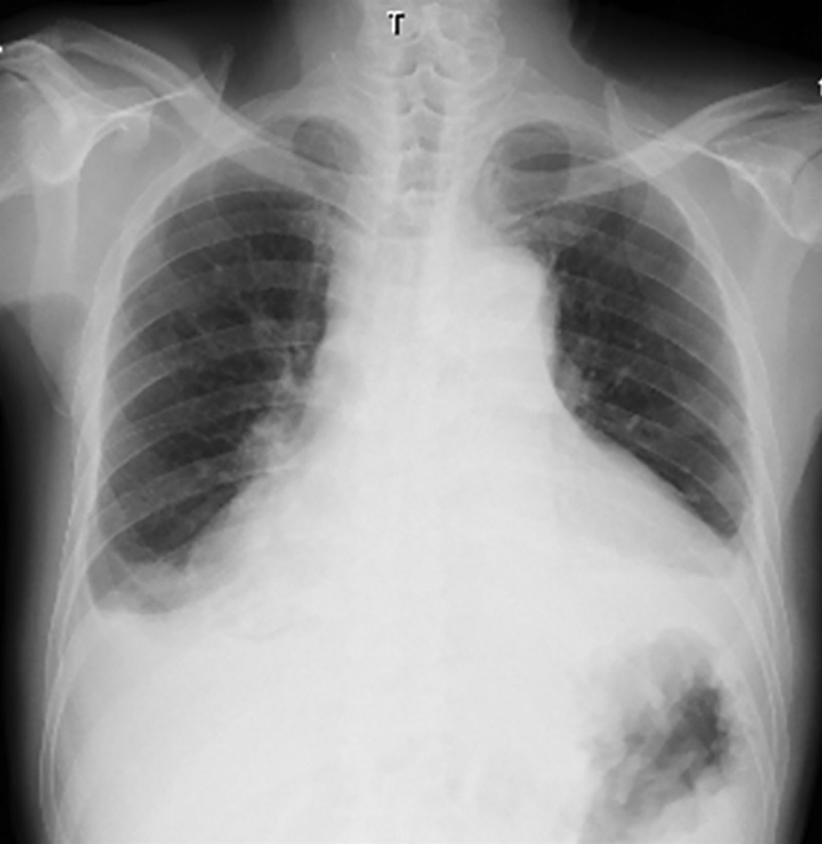 Successful treatment with lenvatinib in a patient with thymic carcinoma presenting with cardiac tamponade: a case report and review of literature