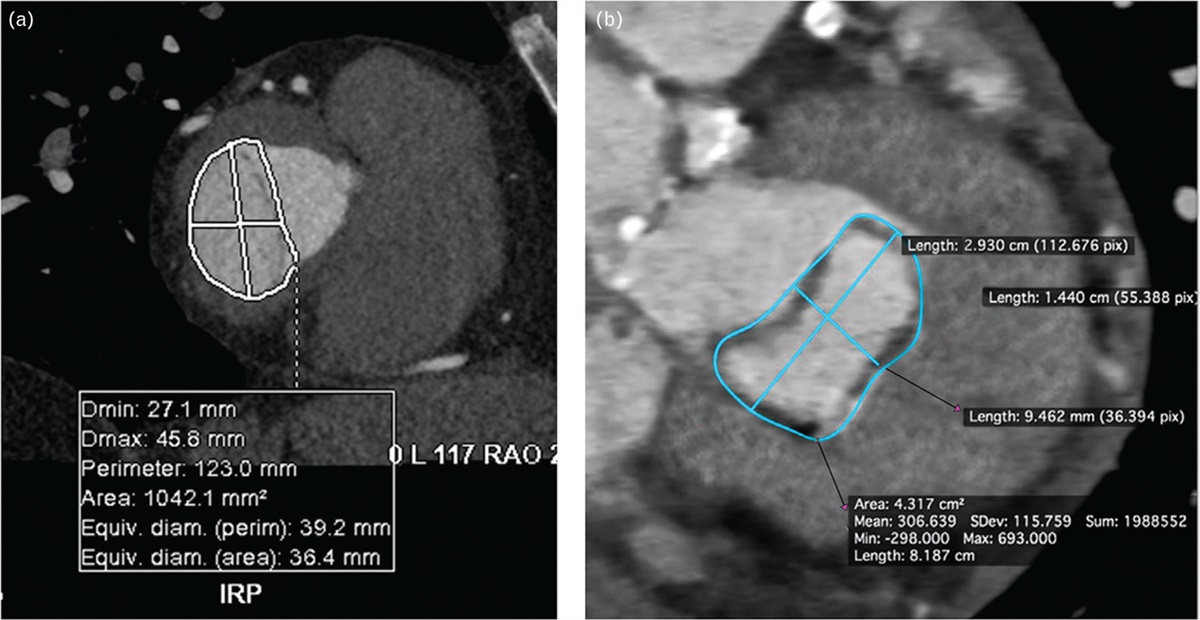 Role of computed tomography in transcatheter replacement of ‘other valves’: a comprehensive review of preprocedural imaging