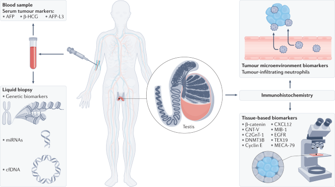Biomarkers of disease recurrence in stage I testicular germ cell tumours