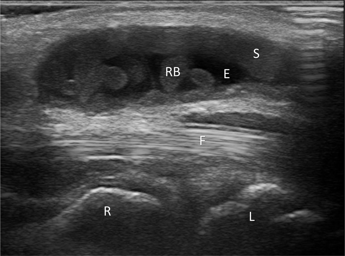 Mycobacterium avium complex Tenosynovitis Mimicking Synovial Chondromatosis