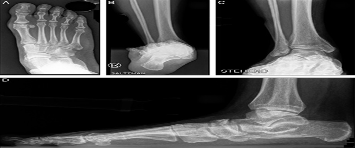 Medial-Single-Incision Double Arthrodesis “Diple” for Adult-acquired Flatfoot Deformity