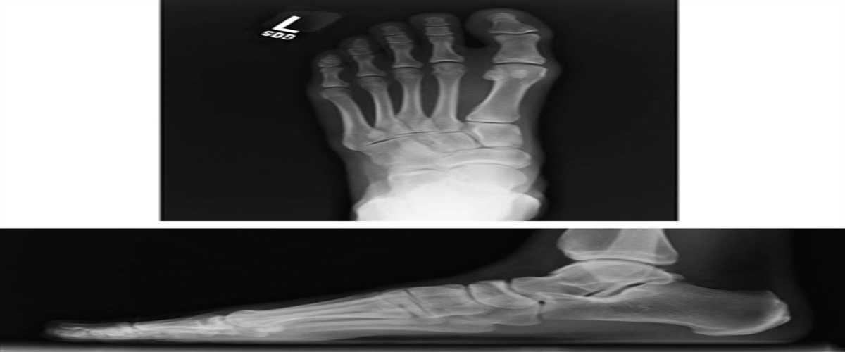 Operative Treatment of Medial and Lateral Sesamoid AVN Through an Isolated Medial Approach