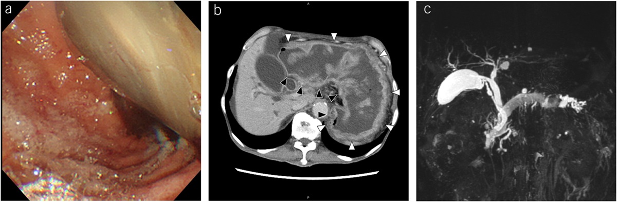 Stomach Without Posterior Wall: Unusual Findings Due to Intraductal Papillary Mucinous Neoplasm