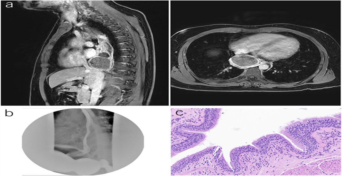 Fever, Chest Pain, and Odynophagia: A Clinical Triad of an Infected Esophageal Duplication Cyst