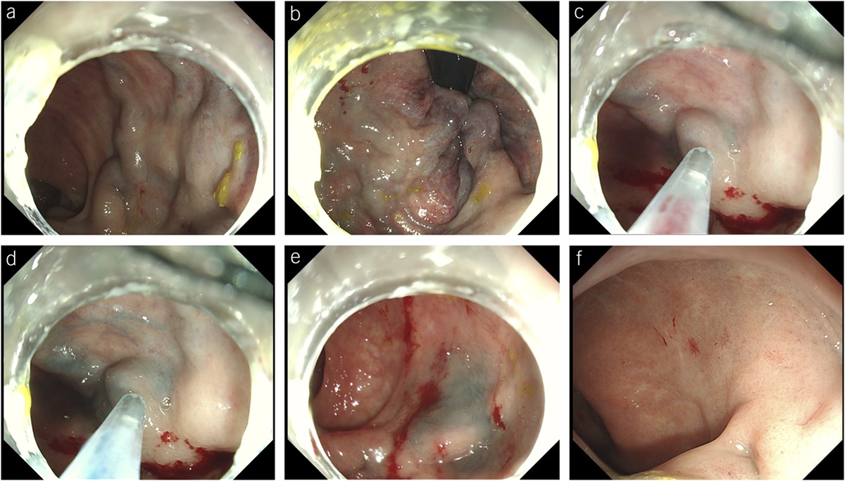 Anorectal Variceal Bleeding Treated by Sclerotherapy