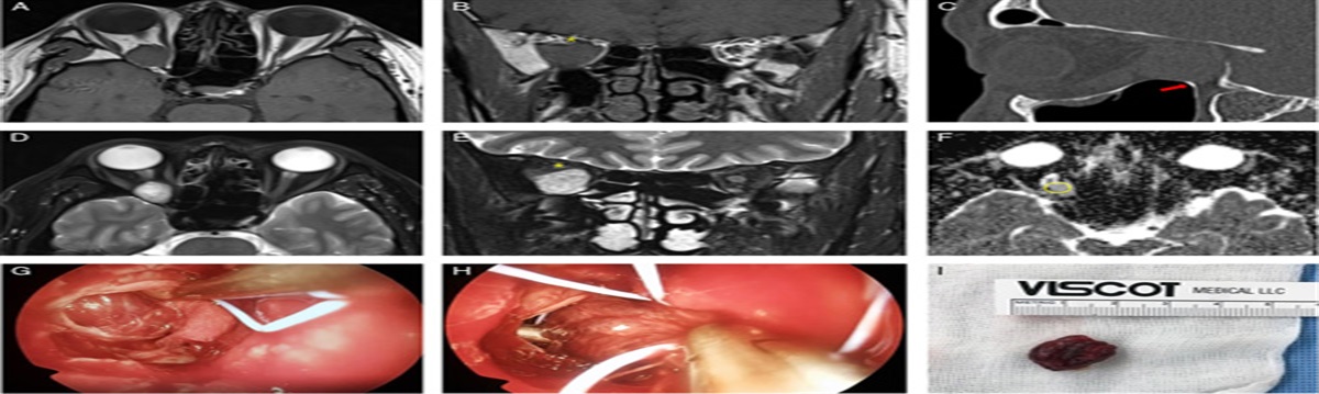 Endonasal Endoscopic Removal of Orbital Cavernous Venous Malformation With Optic Neuropathy