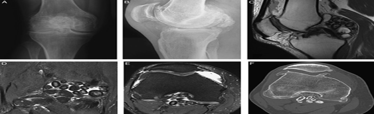 Pearls and Pitfalls of Arthroscopic Posteromedial Portal for Posterior Knee Chondromatosis Surgical Treatment
