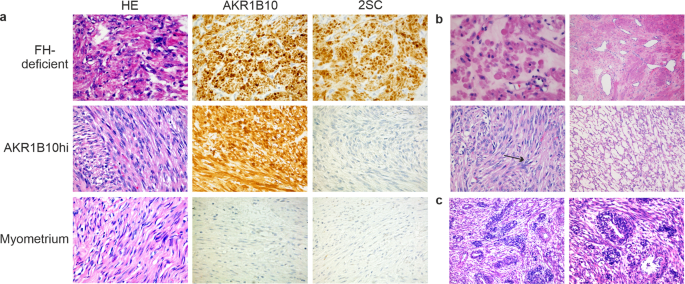 A novel uterine leiomyoma subtype exhibits NRF2 activation and mutations in genes associated with neddylation of the Cullin 3-RING E3 ligase