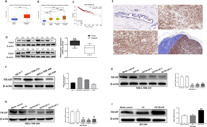 Silencing TRAIP suppresses cell proliferation and migration/invasion of triple negative breast cancer via RB-E2F signaling and EMT