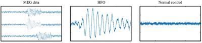 A multi-head self-attention deep learning approach for detection and recommendation of neuromagnetic high frequency oscillations in epilepsy