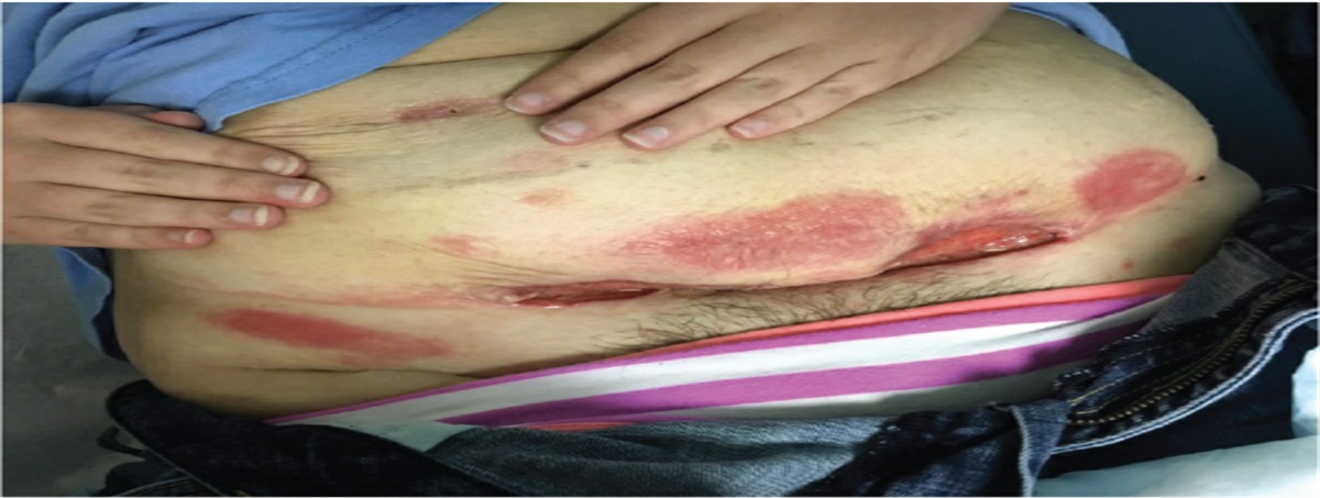 Treatment of Pediatric Pyoderma Gangrenosum With Modified Negative Pressure Wound Therapy and Intralesional Corticosteroids: A Case Report