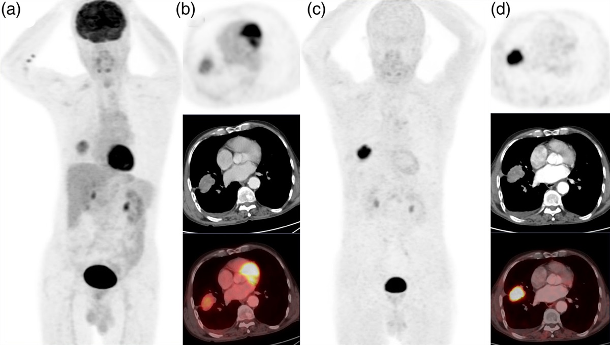 Comparison of 18F-FDG PET/CT and 68Ga-FAPI-04 PET/CT in patients with non-small cell lung cancer