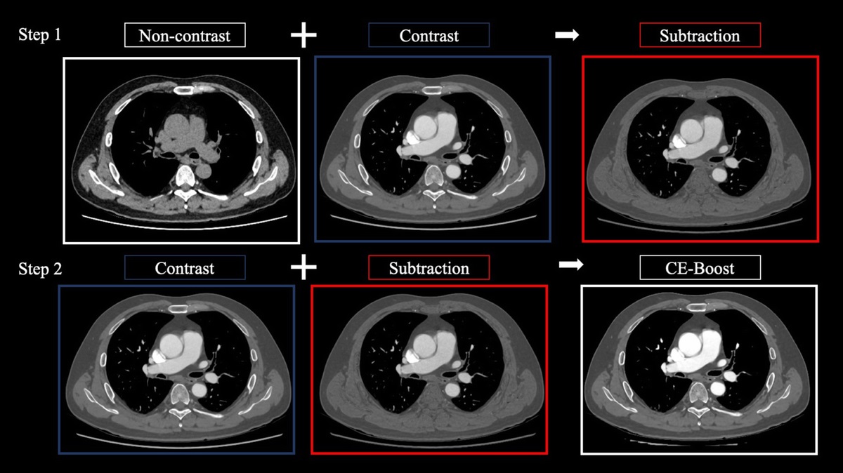 A Novel Computed Tomography Image Reconstruction for Improving Visualization of Pulmonary Vasculature: Comparison Between Preprocessing and Postprocessing Images Using a Contrast Enhancement Boost Technique