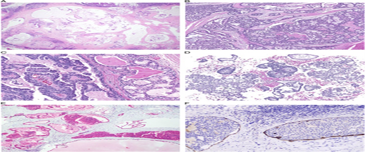 Salivary Gland Intraductal Carcinoma: How Do 183 Reported Cases Fit Into a Developing Classification