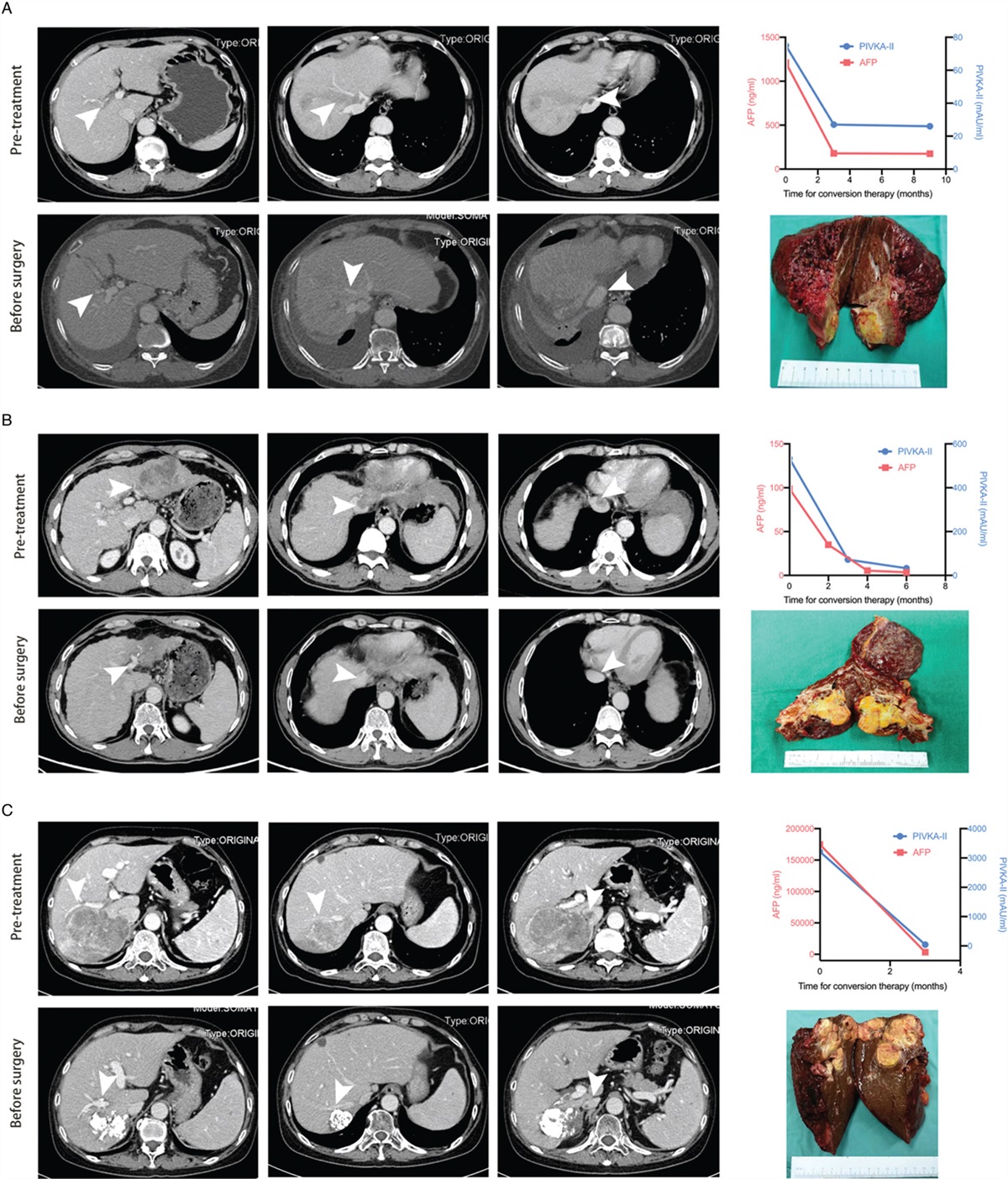 Conversion resection for patients with hepatocellular carcinoma and inferior vena cava tumor thrombus: a consecutive case series