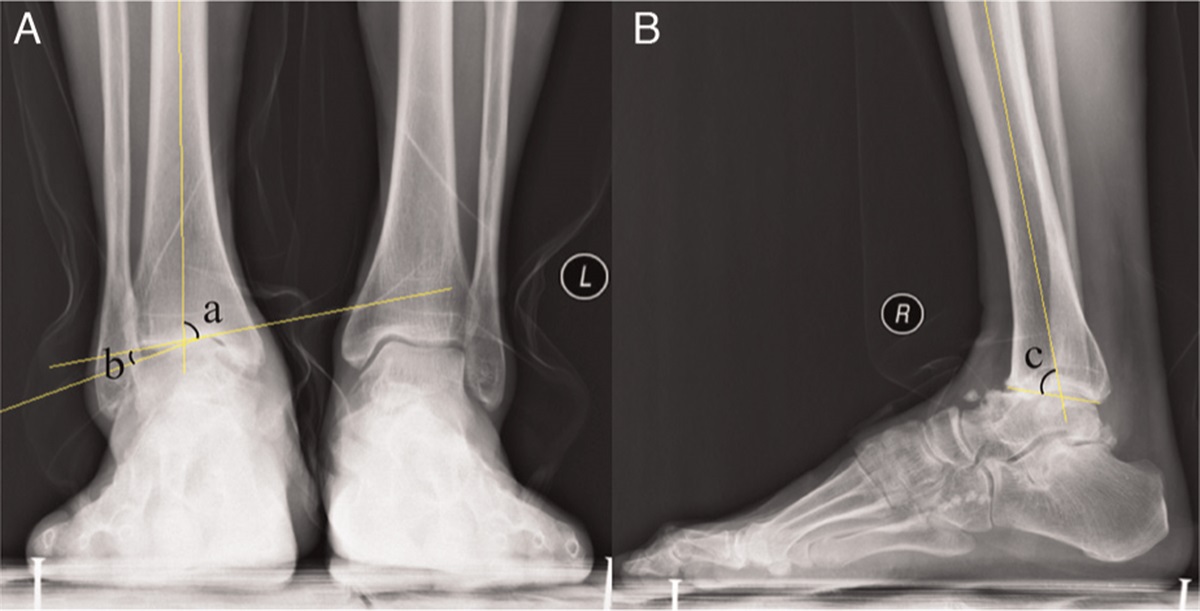 Total ankle replacement with INBONE-II prosthesis: A short-to- medium-term follow-up study in China