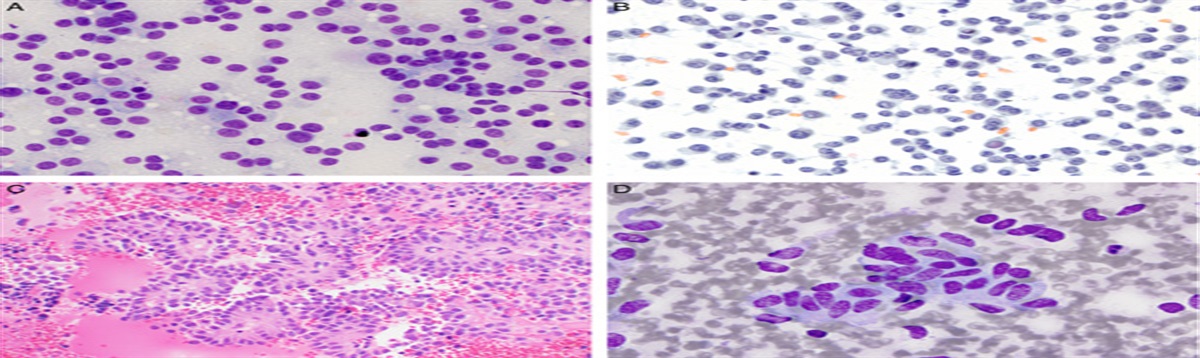 Small Biopsy and Cytology of Pulmonary Neuroendocrine Neoplasms: Brief Overview of Classification, Immunohistochemistry, Molecular Profiles, and World Health Organization Updates