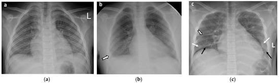 Gastroenterology Insights, Vol. 13, Pages 313-325: Abdominal and Thoracic Imaging Features in Children with MIS-C