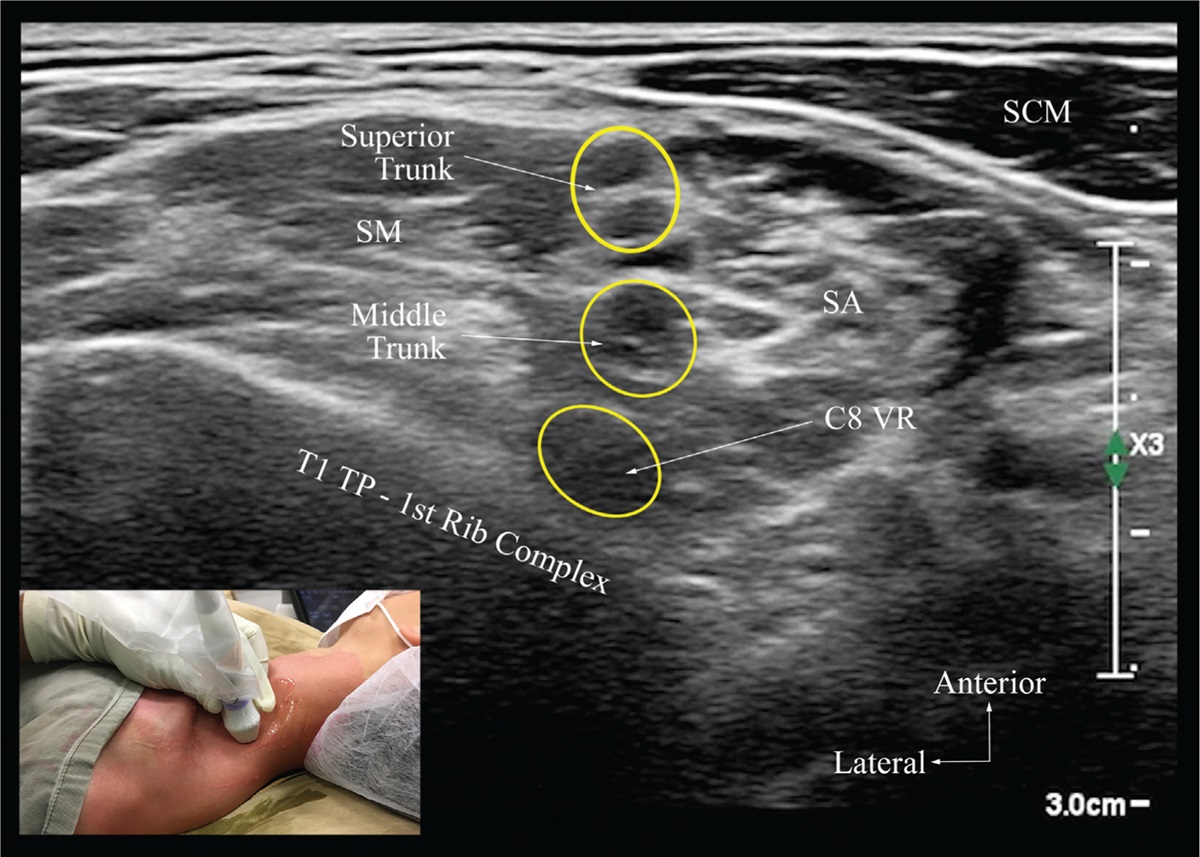 Ultrasound-guided selective trunk block: Evaluation of ipsilateral sensorimotor block dynamics, hemidiaphragmatic function and efficacy for upper extremity surgery. A single-centre cohort study