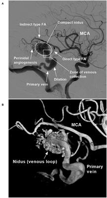 Intra- and post-operative acute hemorrhagic complications of Onyx embolization of brain arteriovenous malformations: A single-center experience