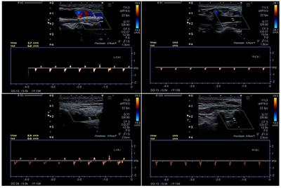 Exclusive color-coded duplex sonography of extracranial vessels reliably confirms brain death: A prospective study